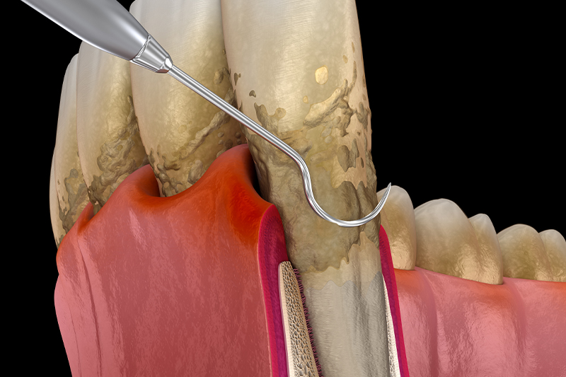 Gum Disease / Periodontal Treatment in Cincinnati